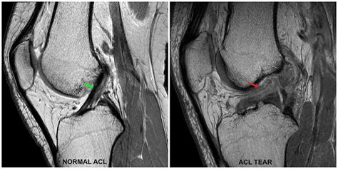 torn acl mri vs normal